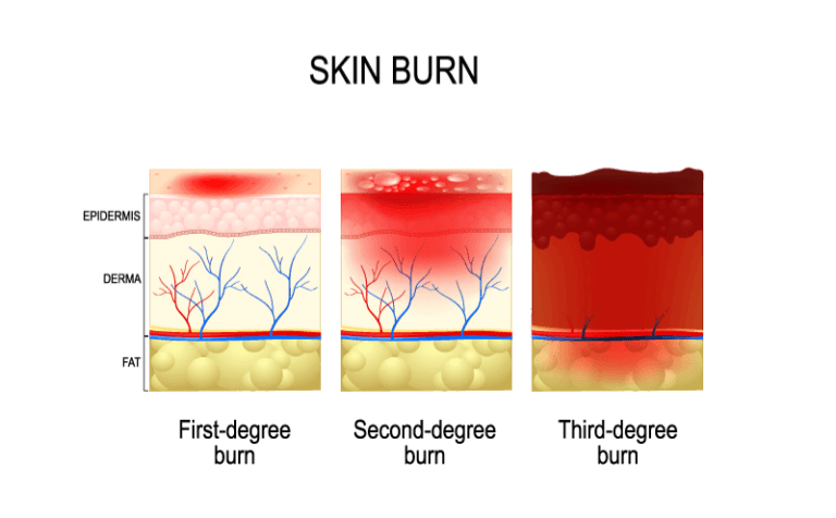 Depth of burn
